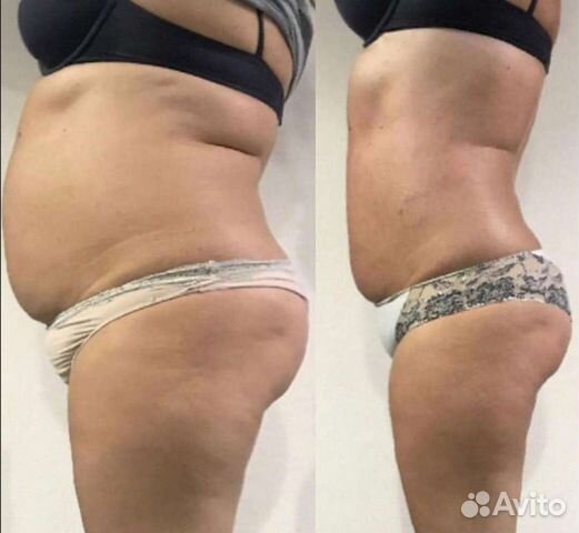 Антицеллюлитный массаж. Кавитация.RF-лифтинг