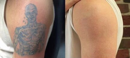 Удаление тату лазером