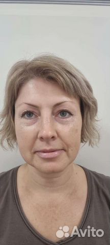 Смас лифтинг